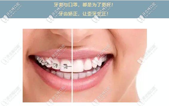 牙齒正畸就選傳統(tǒng)金屬箍牙套