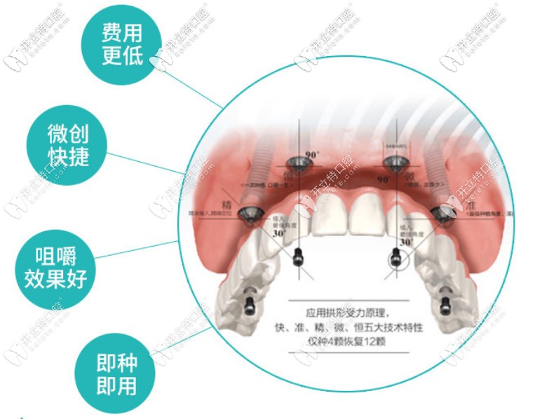 成都團(tuán)圓口腔做韓國登騰半口即刻負(fù)重種植牙的價(jià)格上線啦
