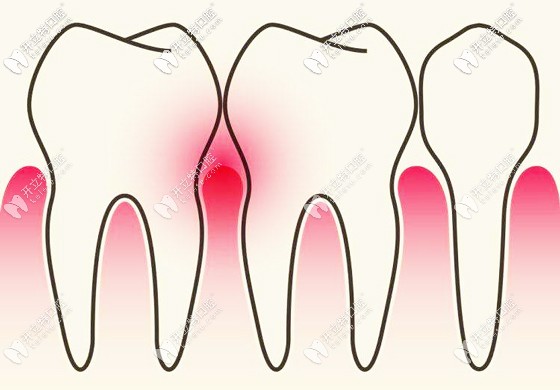 牙周炎癥示意圖