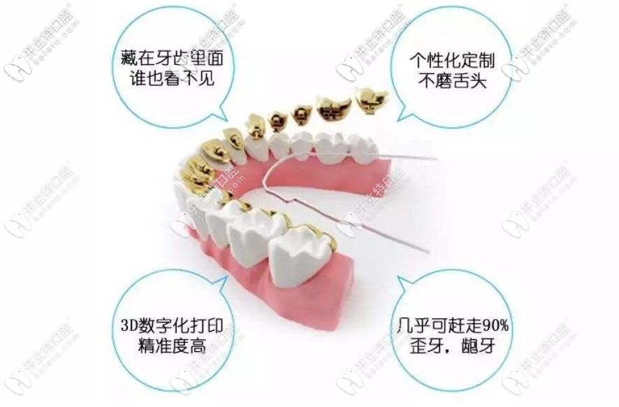 舌側(cè)矯正優(yōu)勢