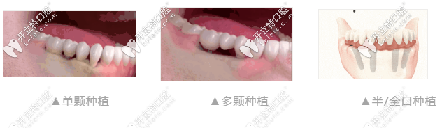 做種植牙類別圖