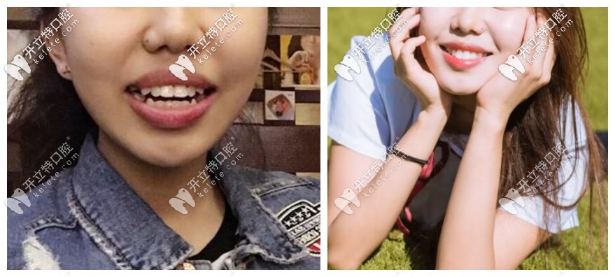 分享帖:北京禾禾齒科張棟梁做隱適美矯正怎么樣?收費(fèi)貴不