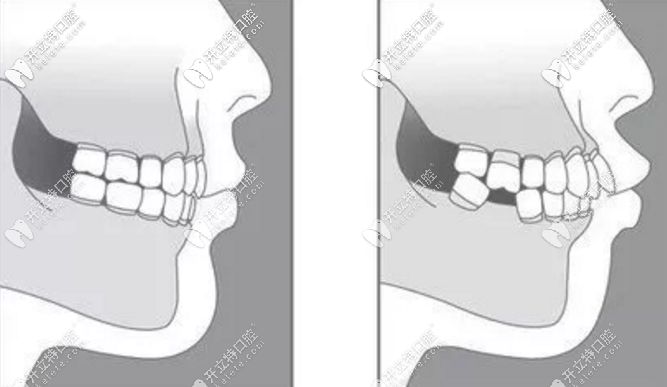 缺牙不能拖要及時(shí)醫(yī)治