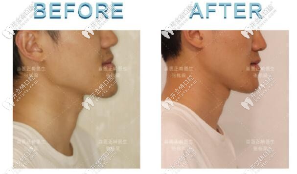 骨性III類地包天小哥哥，矯正后側(cè)臉對(duì)比圖