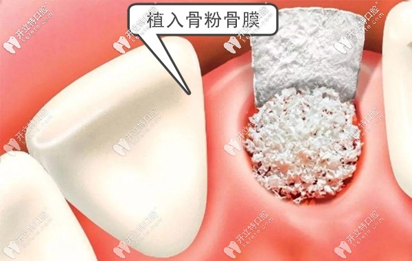 牙齦植入的骨粉骨膜示意圖