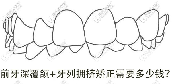 牙列擁擠+深覆合，想矯正牙齒做手術(shù)需要多少錢呢？