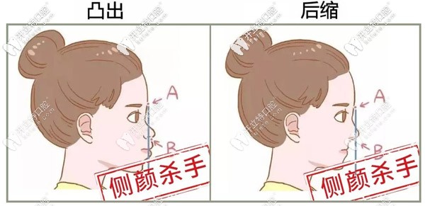 深覆合會導致臉型不好看