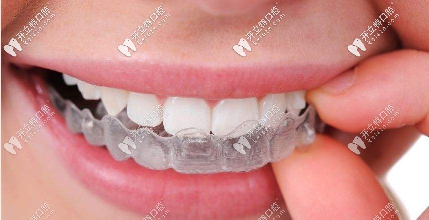 全透明牙套佩戴上的樣子