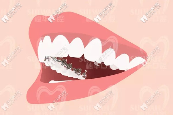 廣州穗華口腔引進(jìn)3M Incognito黃金舌側(cè)矯治系統(tǒng)