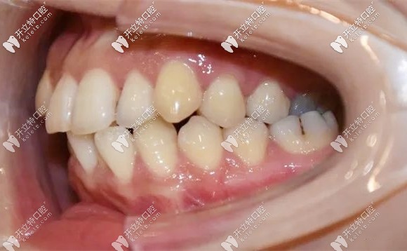 矯正前牙齒的側(cè)面樣子 矯正前牙齒的側(cè)面樣子