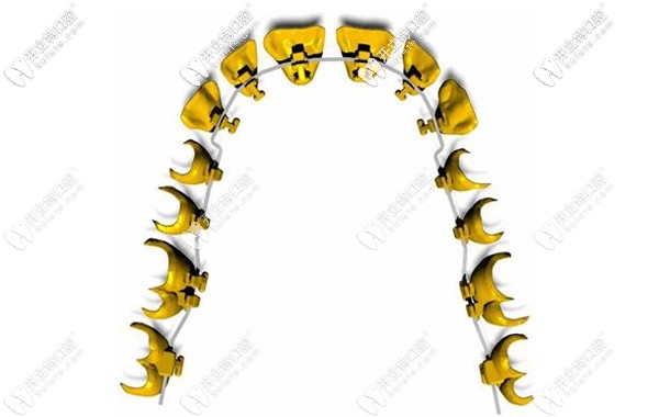 美國(guó)3M Incognito黃金舌側(cè)隱形矯治器