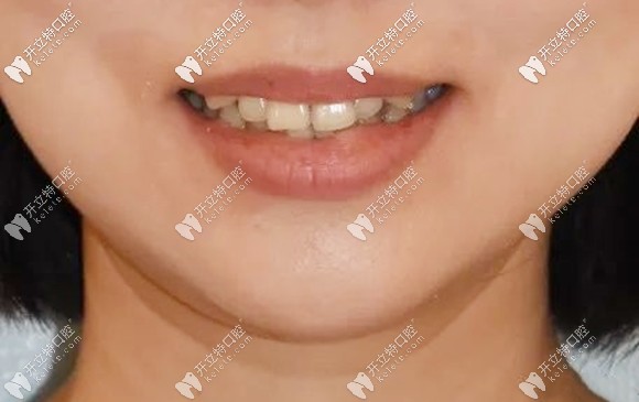 矯正牙齒前的留照 矯正牙齒前的留照