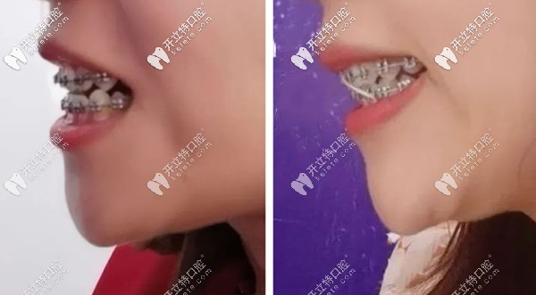 牙齒開(kāi)頜矯正效果圖