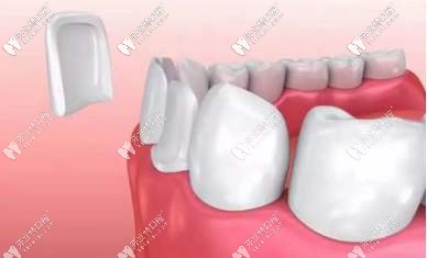 牙齒貼面