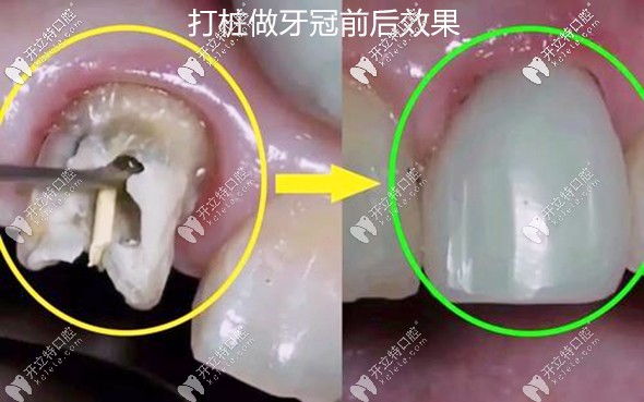 缺損牙打樁做冠前后效果圖