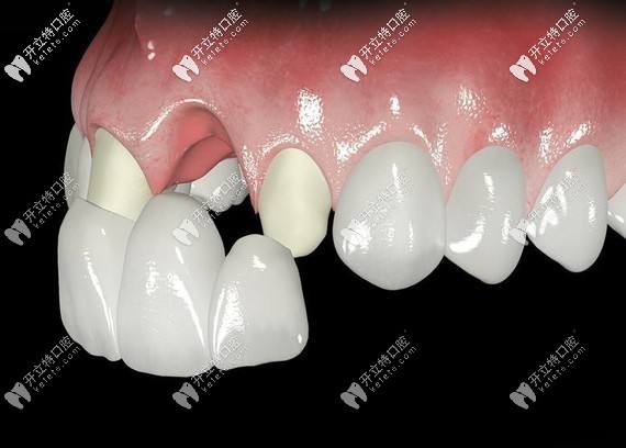 全瓷牙套的壽命是幾年?能用一輩子嗎？