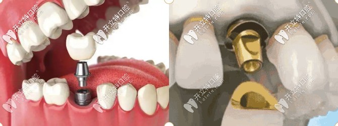 無錫佳士潔口腔種植牙價(jià)格不貴(2575-4875元起)口碑評論點(diǎn)贊多