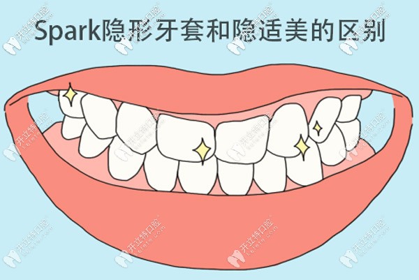 Spark隱形牙套和隱適美哪個(gè)好，區(qū)別是什么？