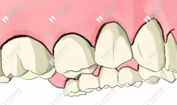 種牙前后的效果對比圖