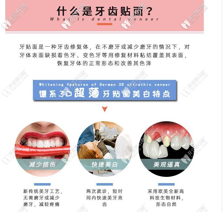 牙齒貼面及其特點(diǎn)介紹