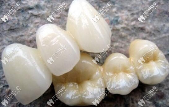 二氧化鋯全瓷牙