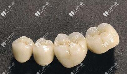 金屬烤瓷牙崩瓷