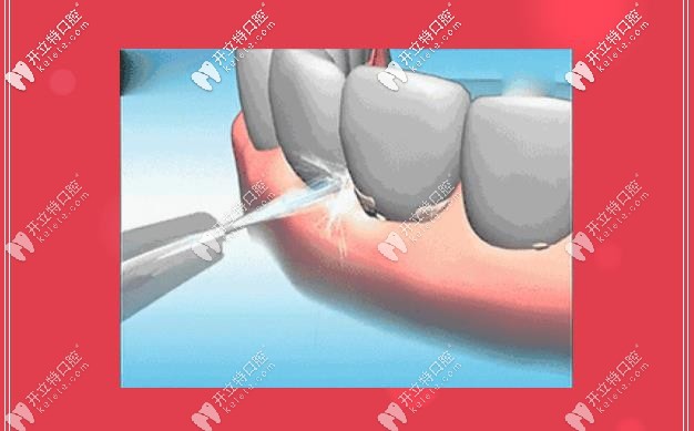 洗牙，給你牙齒干凈清爽