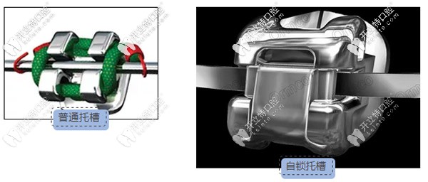 美國奧美科damon Q自鎖托槽