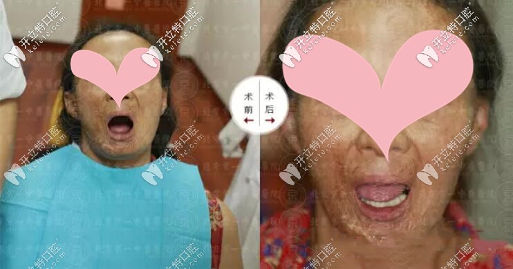 63歲王姨在北京京一口腔做allon4下半口種植牙只用了30分鐘