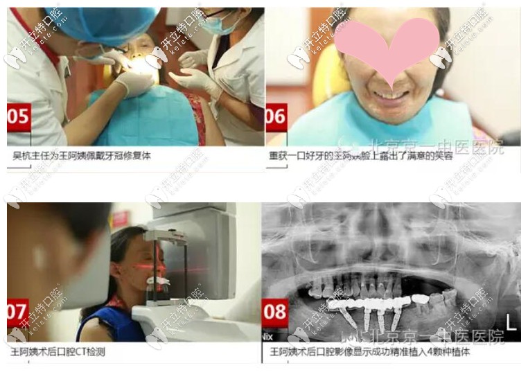 京一口腔為王阿姨做allon4半口種植牙的詳細(xì)過程