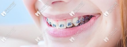 汕頭口碑好的華美口腔牙齒矯正價(jià)格上線，呼叫需整牙的你