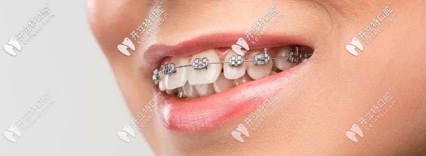 金屬自鎖托槽牙套