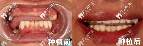 種植牙前后對比