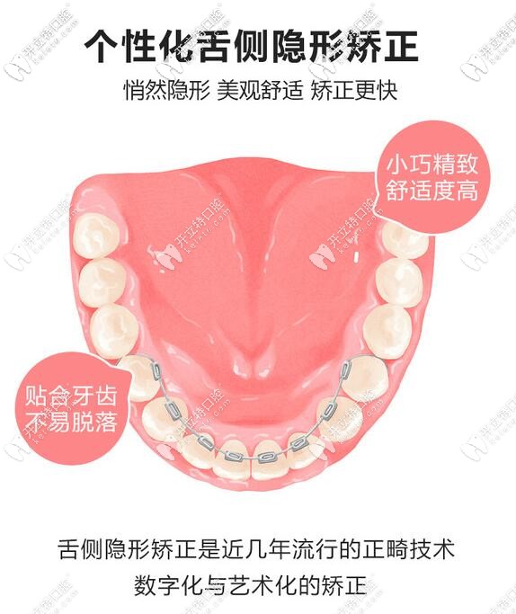個性化舌側矯正的優(yōu)勢