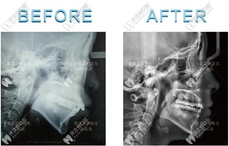 張棟梁做過的骨性齙牙病例對比圖