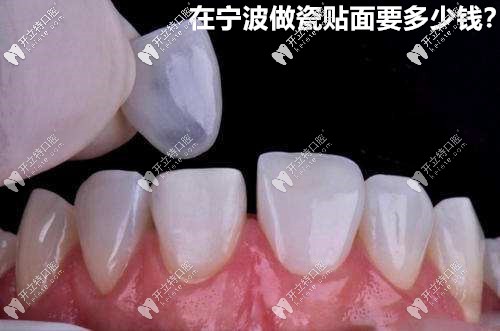 寧波做牙齒超薄全瓷貼面要多少錢(qián),附醫(yī)院推薦哦！