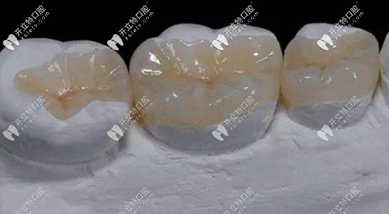 樹脂補牙的外觀