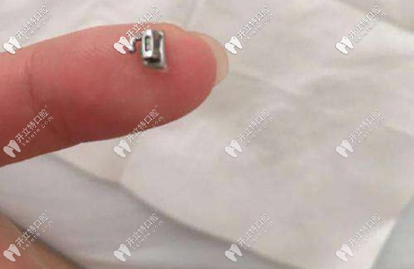 托槽掉了還能再用嗎，該如何處理？