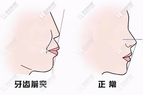 牙齒前突的來看看煙臺圣貝口腔矯正牙齒怎么樣