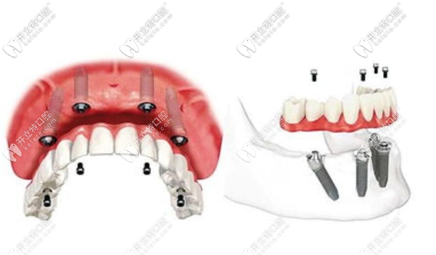 all-on-4全口種植牙示意圖