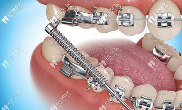 正畸托槽老是掉怎么辦，托槽掉了對矯正牙齒有影響嗎