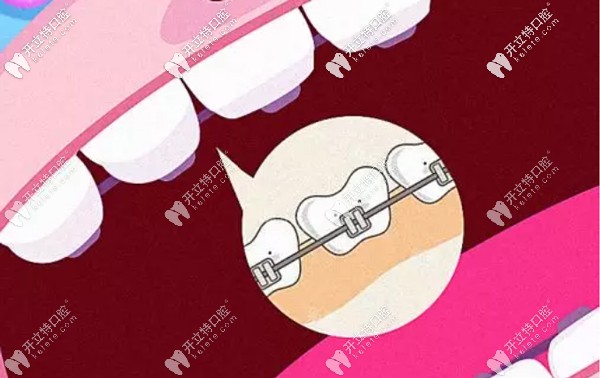 舌側(cè)隱形矯正的優(yōu)勢(shì)