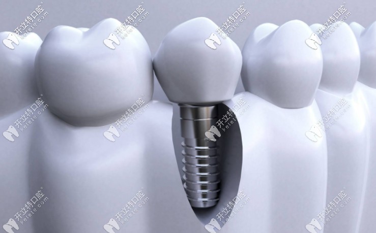 成都種植全口牙的價(jià)格是多少？附種牙醫(yī)生推薦！