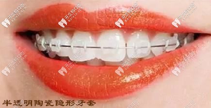 半透明陶瓷隱形牙套