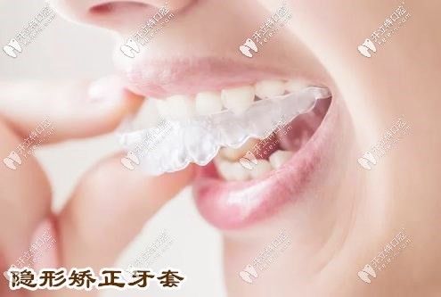 隱形矯正牙套