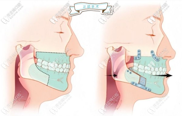 來(lái)聊聊我們廣州做正頜手術(shù)哪家醫(yī)院好且收費(fèi)還不太貴...