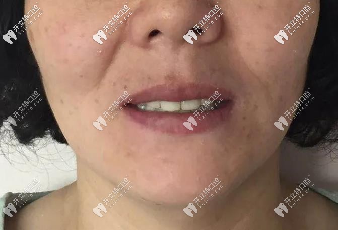 李女士做完種植的照片 李女士做完種植的照片