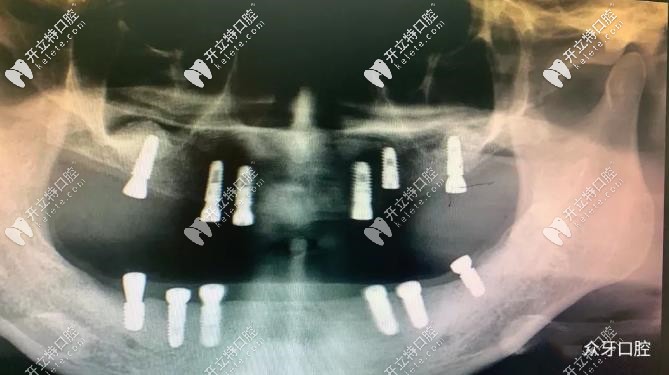 李女士做全口12顆種植牙的CT片 李女士做全口12顆種植牙的CT片