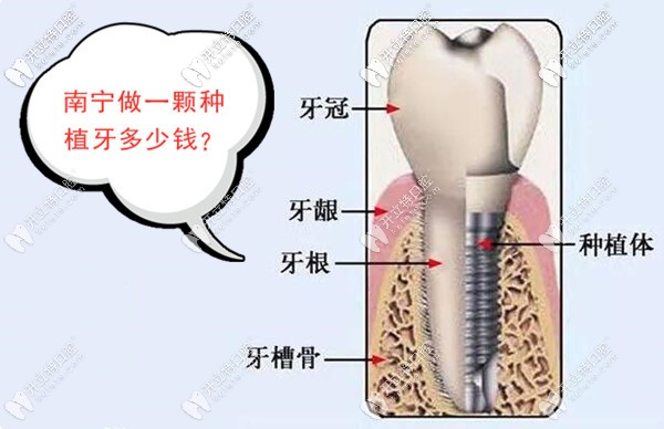 南寧做種植牙的價格是多少錢