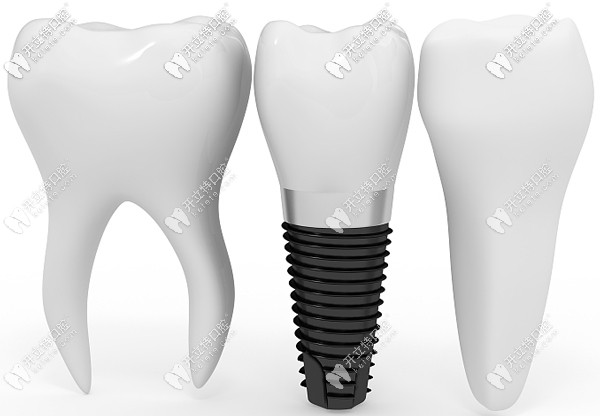 廣州市天河區(qū)的種植牙